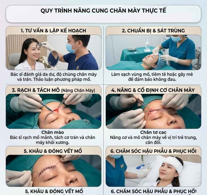 Quy trình nâng cung chân mày
