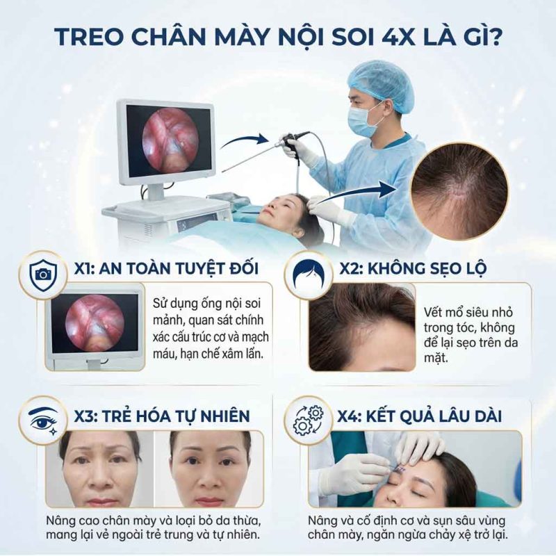 Treo cung chân mày nội soi 4X là gì?
