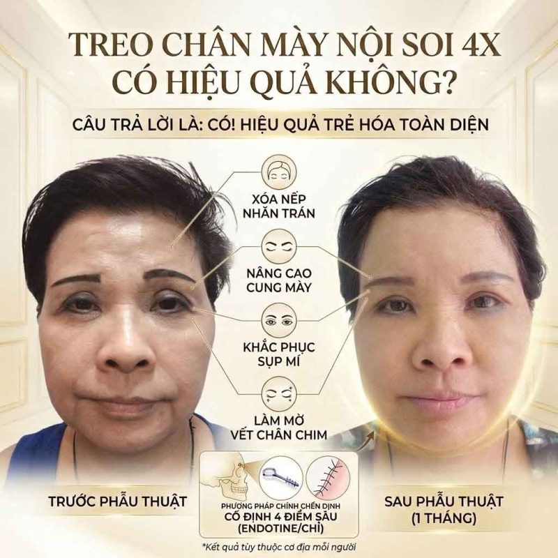 Treo cung chân mày nội soi 4x có hiệu quả không