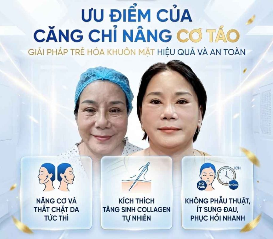 Ưu điểm của căng chỉ nâng cơ táo 