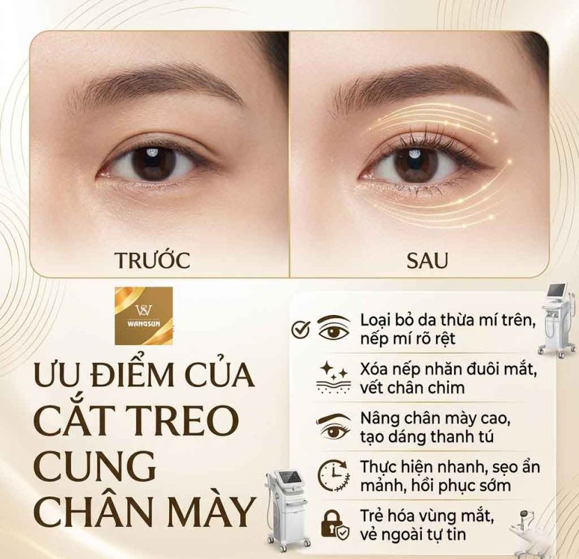 Ưu điểm của cắt treo cung chân mày