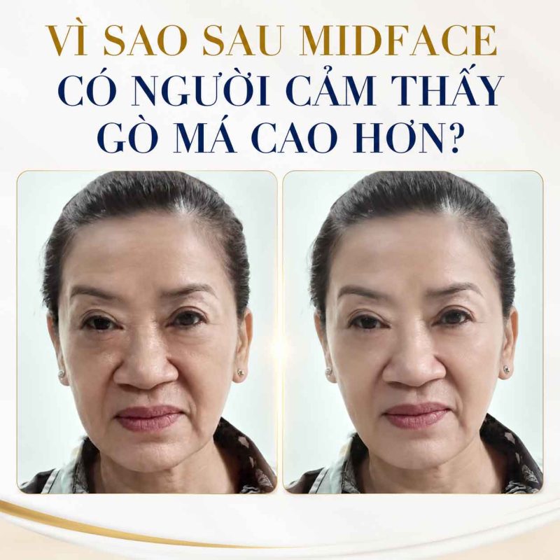 Cấy Midface Có Làm Cao Gò Má Không? Giải Đáp Sự Thật Bạn Cần Biết Vì sao sau midface có người cảm thấy gò má cao hơn
