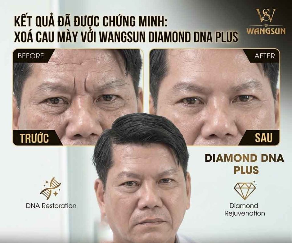 Xóa cau mày Wangsun diamond dna plus