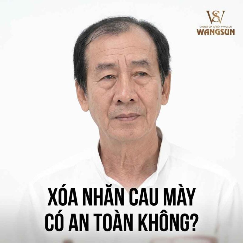 Làm Sao Để Hết Cau Mày? 10 Cách Xóa Nếp Nhăn Giữa Trán Hiệu Quả Xóa nhăn cau mày có an toàn không?