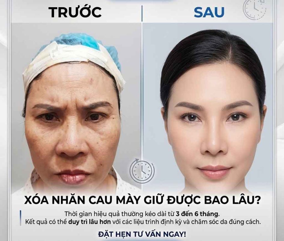 Làm Sao Để Hết Cau Mày? 10 Cách Xóa Nếp Nhăn Giữa Trán Hiệu Quả Xóa nhăn cau mày giữ được bao lâu