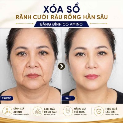Xóa sổ rãnh cười đính cơ amino