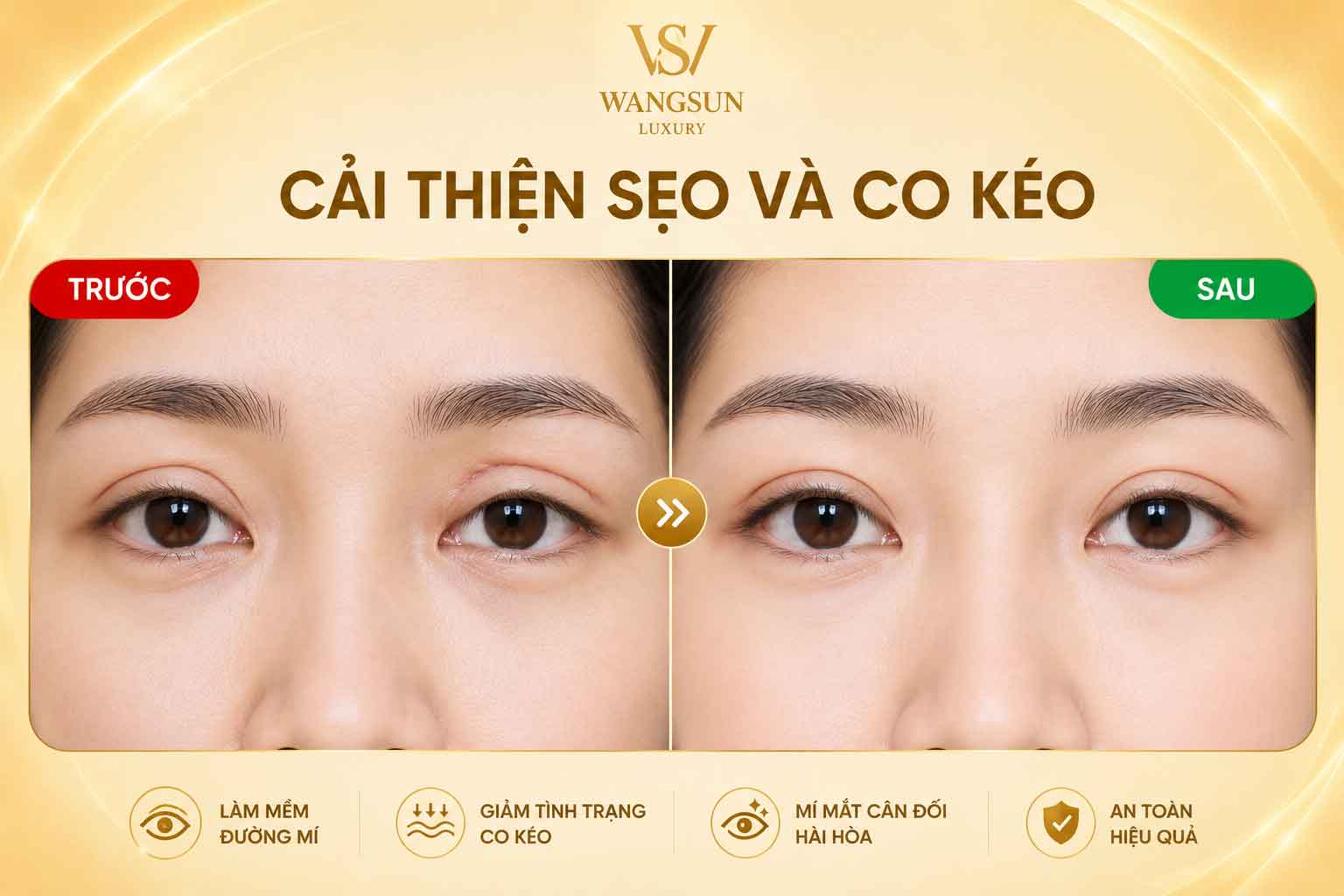 Cải thiện sẹo co kéo