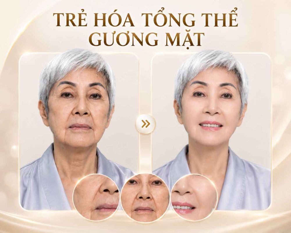 Cắt Bọng Mắt Dưới Bao Lâu Thì Hồi Phục? Quá Trình Lành Thương Theo Từng Giai Đoạn Trẻ hóa tổng thể gương mặt
