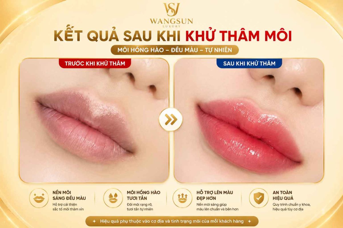Trước sau khử thâm môi