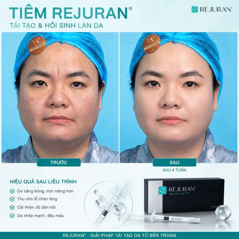 Trước sau tiêm rejuran Wangsun Luxury