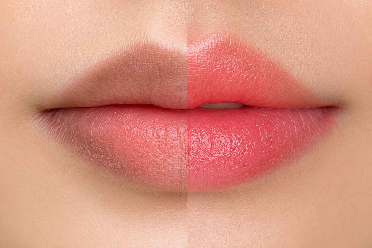 Khử Thâm Môi Mất Bao Nhiêu Phút? Quy Trình Thực Hiện Có Nhanh Không?