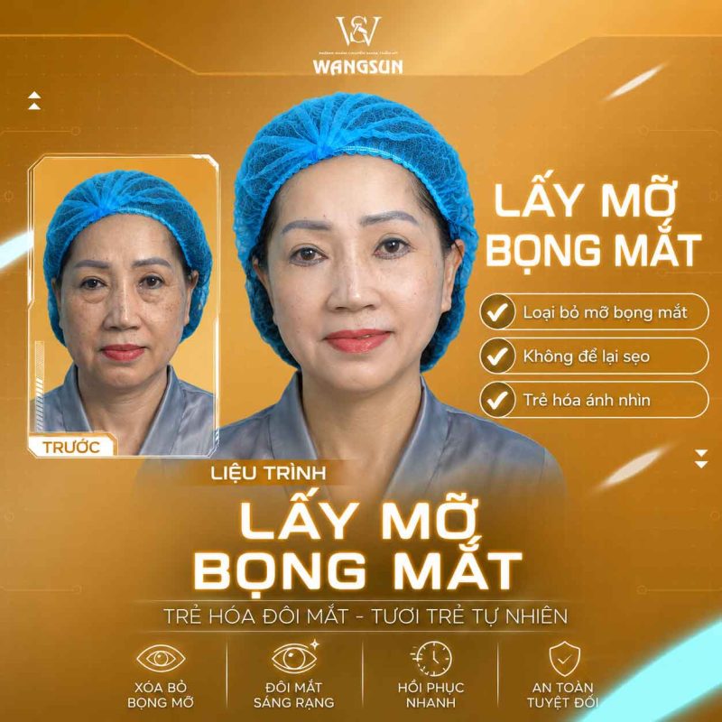 Lấy Mỡ Bọng Mắt Dưới Bao Lâu Thì Hồi Phục? Thời Gian Lành Thương Và Cách Chăm Sóc Sau Phẫu Thuật Lấy bọng mỡ mắt