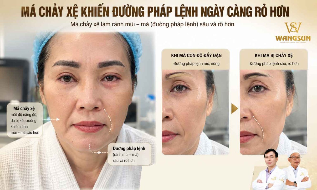 má chảy xệ gây ra đường pháp lệnh