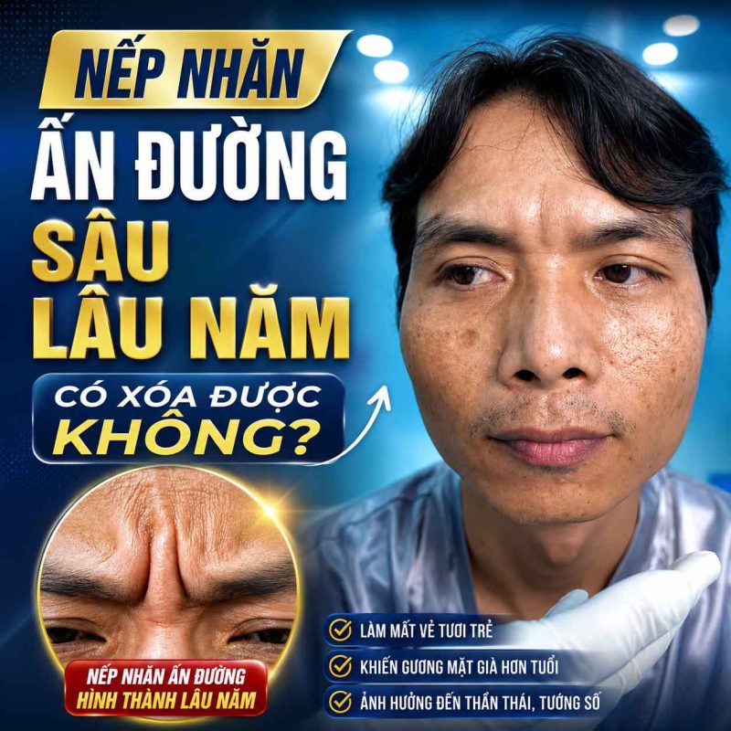 Nếp Nhăn Ấn Đường Sâu Lâu Năm Có Xóa Được Không? Các phương pháp cải thiện