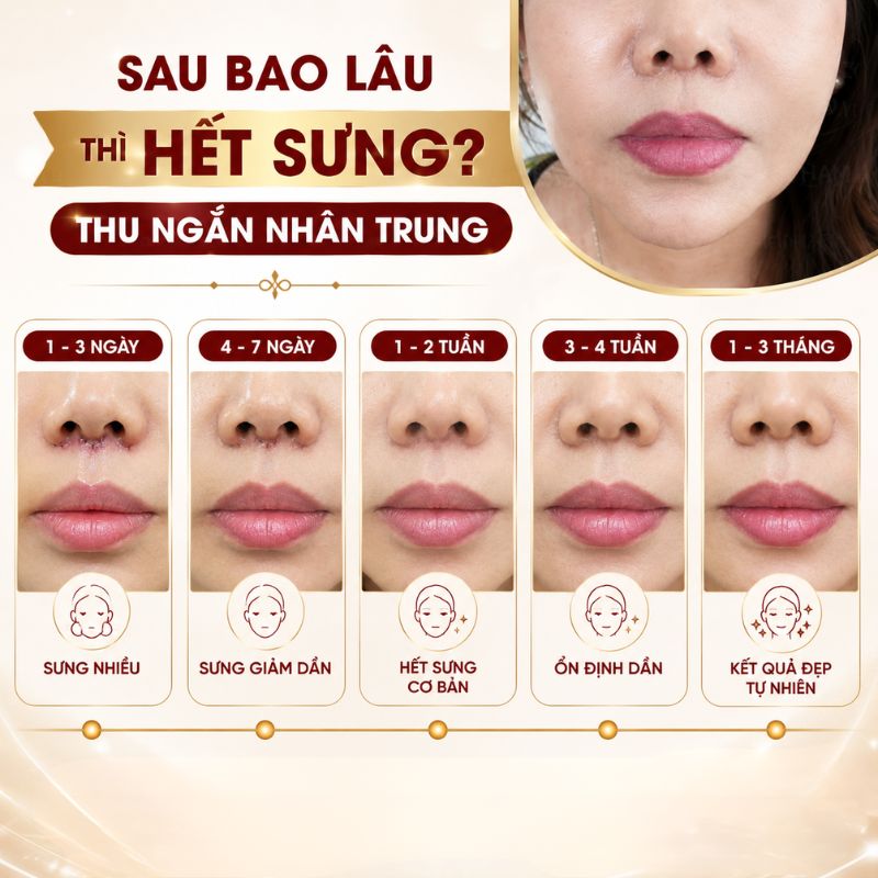 Thu Ngắn Nhân Trung Bao Lâu Thì Hồi Phục? Thời Gian Lành Thương Và Những Điều Cần Biết Thu ngắn nhân trung bao lâu thì hết sưng
