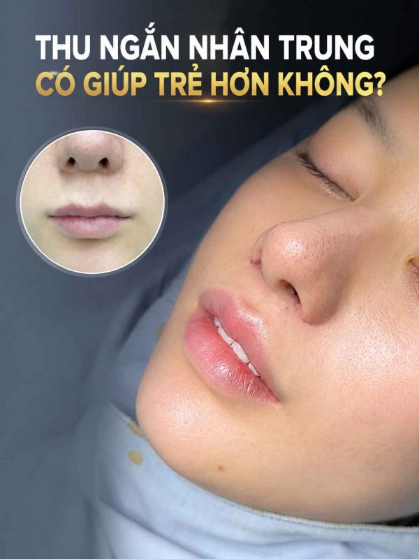 Có Nên Thu Ngắn Nhân Trung Không? Khi Nào Nên Cân Nhắc Cải Thiện? Thu ngắn nhân trung có giúp trẻ hơn không