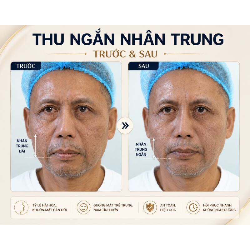 Có Nên Thu Ngắn Nhân Trung Không? Khi Nào Nên Cân Nhắc Cải Thiện? Thu ngắn nhân trung nam giới trước sau