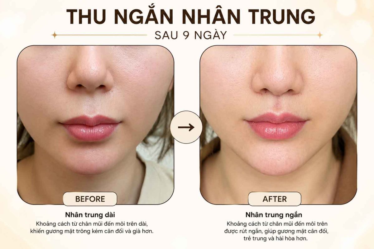 Top 15 Câu Hỏi Thường Gặp Về Thu Ngắn Nhân Trung Thu ngắn nhân trung trước sau thực hiện