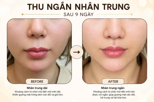 Có Nên Thu Ngắn Nhân Trung Không? Khi Nào Nên Cân Nhắc Cải Thiện? Thu ngắn nhân trung trước sau thực hiện