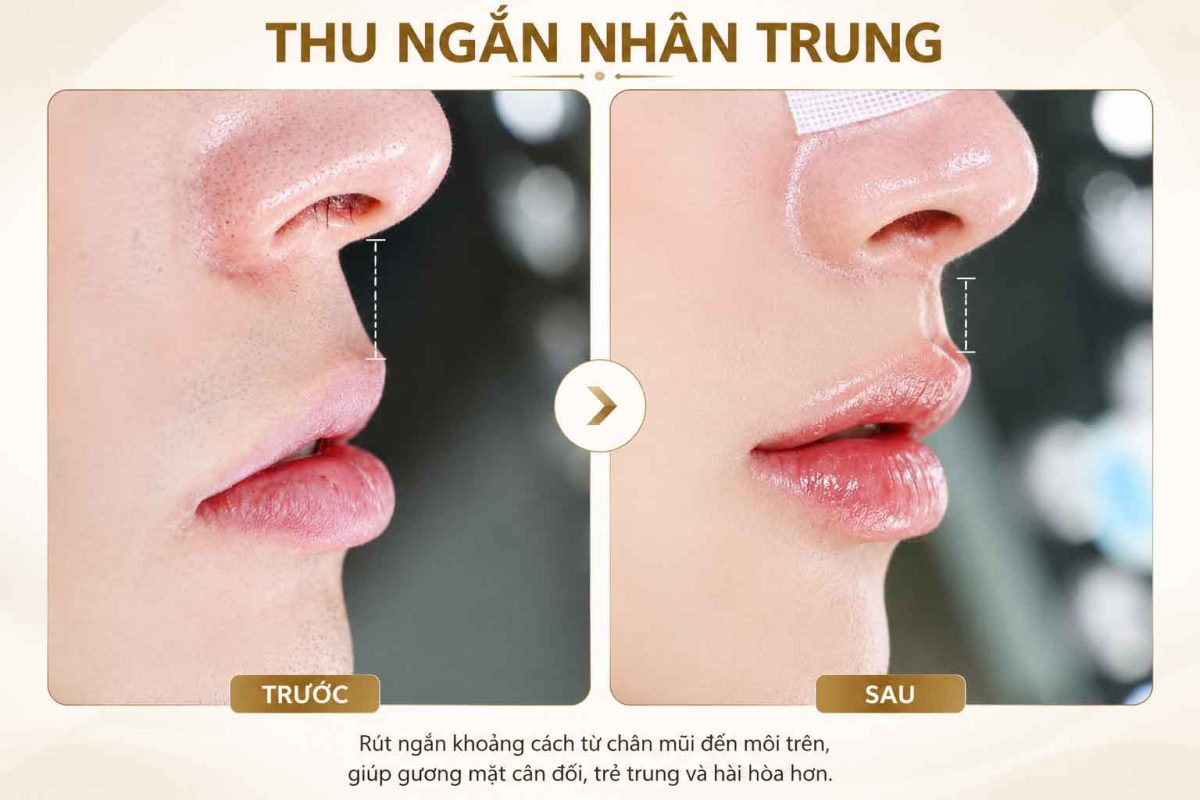 Nhân Trung Dài Ở Nữ Có Xấu Không? Đặc Điểm, Nguyên Nhân Và Cách Cải Thiện Thu ngắn nhân trung trước sau thực hiện