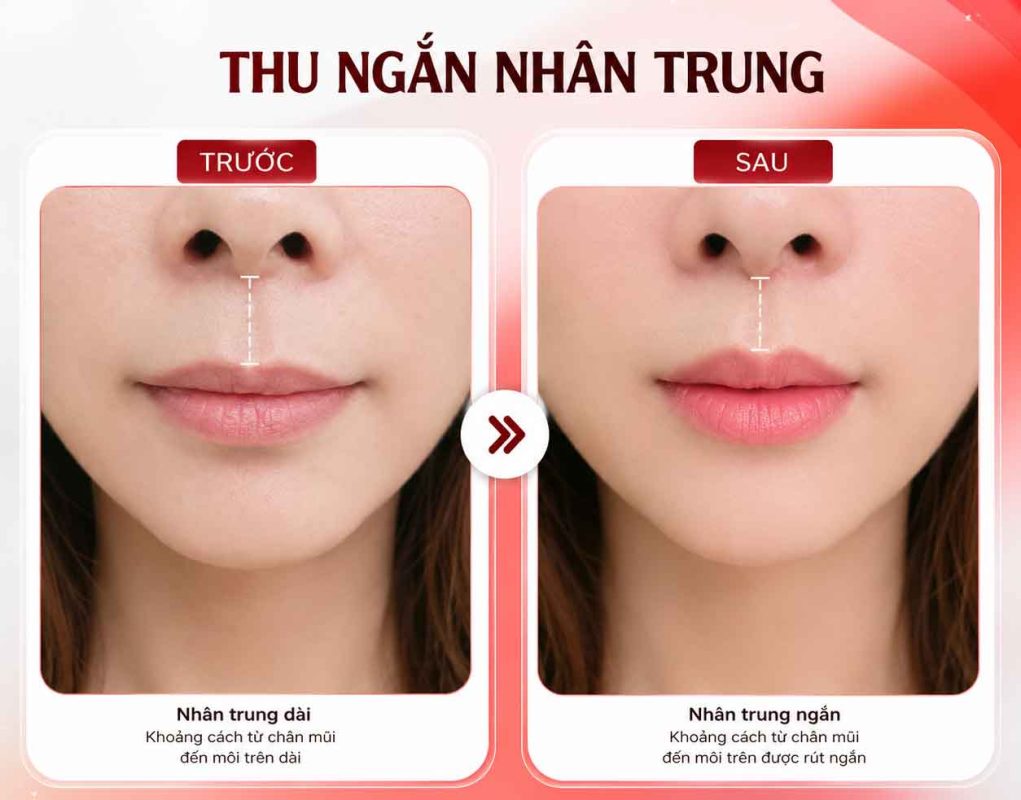 Nhân Trung Dài Ở Nữ Có Xấu Không? Đặc Điểm, Nguyên Nhân Và Cách Cải Thiện Thu ngắn nhân trung trước sau thực hiện