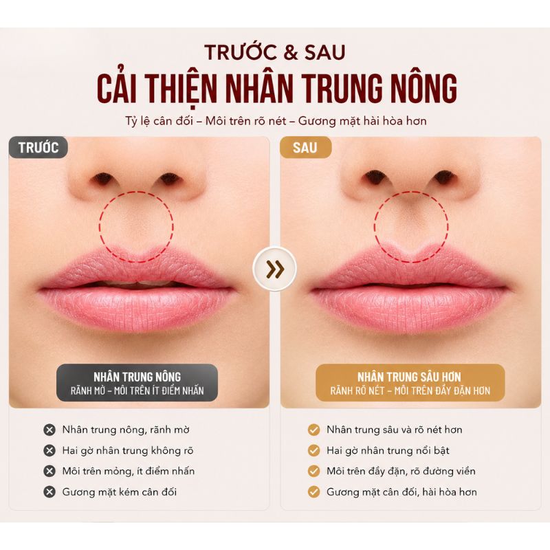 Trước sau cải thiện nhân trung nông