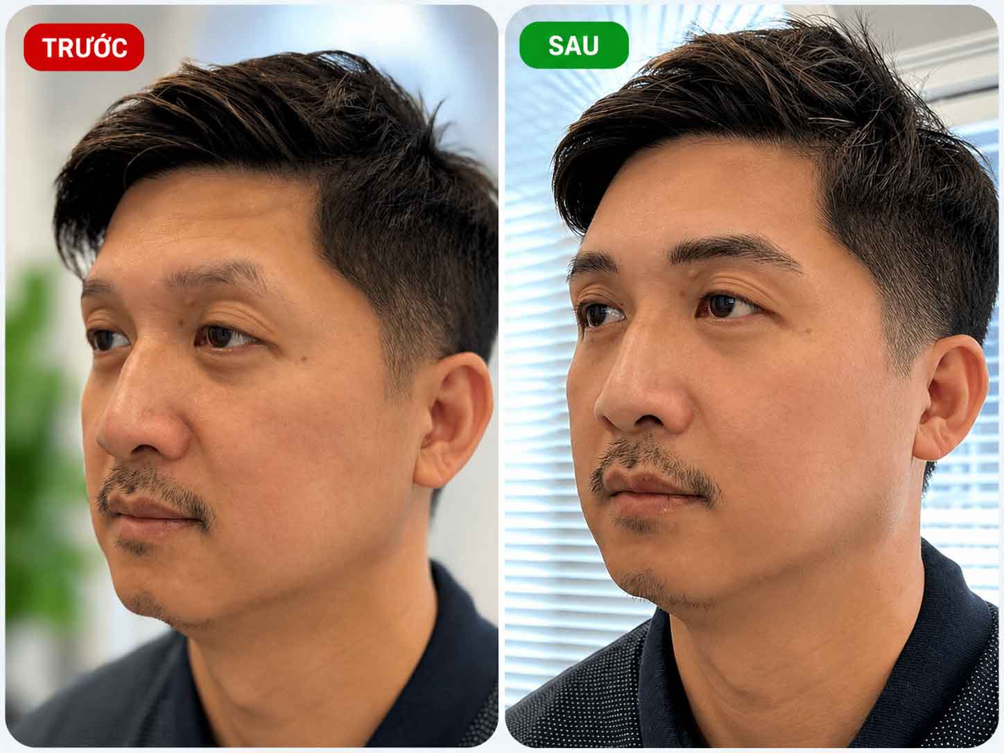 Kết quả phun chân mày nam trước sau