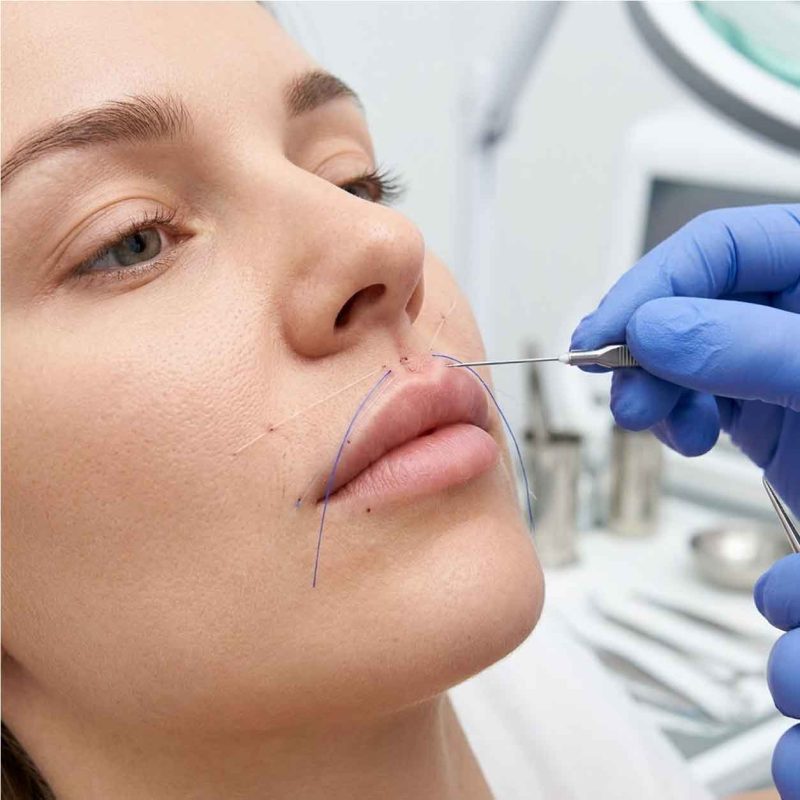 Thu Ngắn Nhân Trung Bằng Chỉ Có Thật Sự Hiệu Quả Không? Căng chỉ thu ngắn nhân trung