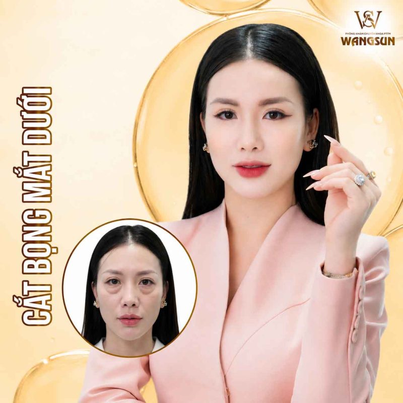 Có Nên Cắt Bọng Mắt Dưới Không? Những Trường Hợp Nên Và Chưa Cần Thực Hiện Cắt bọng mắt dưới