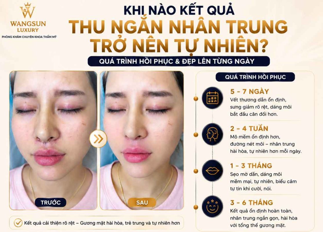 Thu Ngắn Nhân Trung Bao Lâu Thì Hồi Phục? Thời Gian Lành Thương Và Những Điều Cần Biết Khi nào kết quả thu ngắn nhân trung trở nên tự nhiên