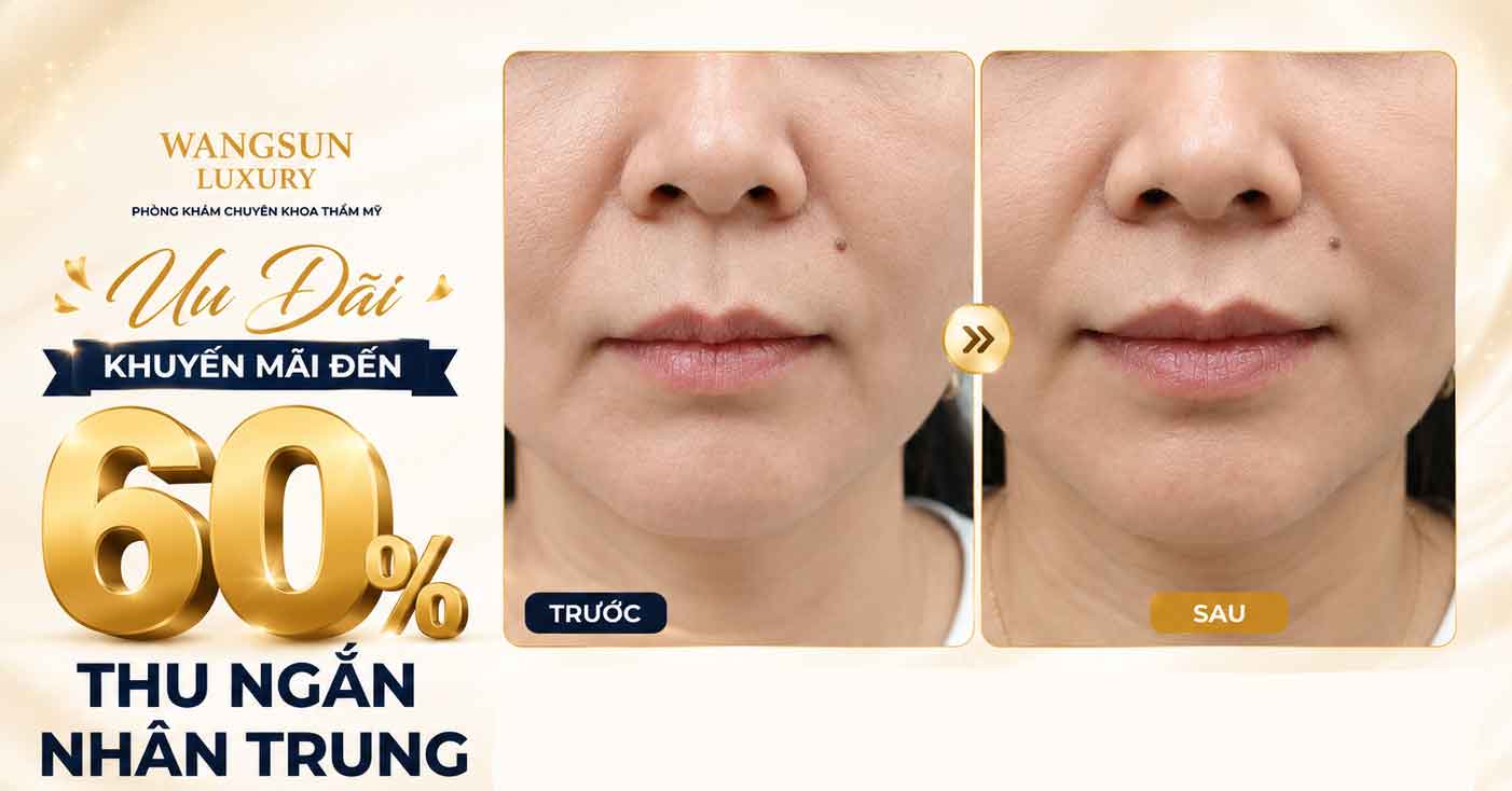 Thu Ngắn Nhân Trung Bao Lâu Thì Hồi Phục? Thời Gian Lành Thương Và Những Điều Cần Biết khuyen mai uu dai thu ngan nhan trung