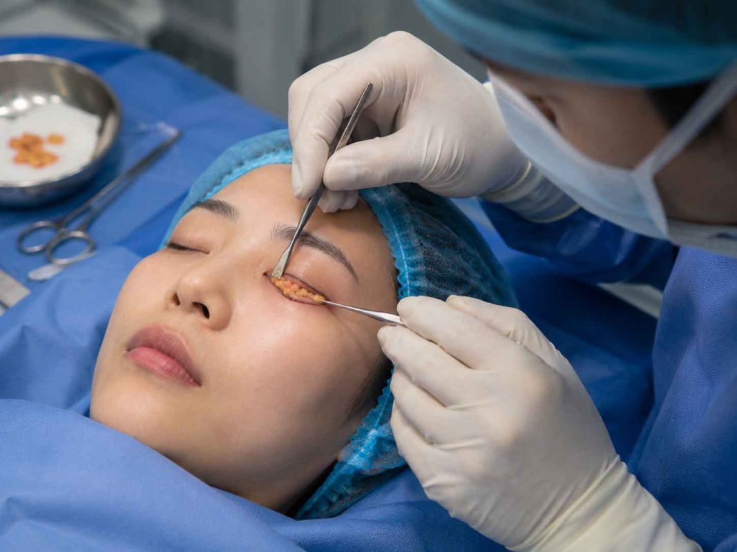 Lấy Mỡ Bọng Mắt Dưới Giá Bao Nhiêu? Cập Nhật Chi Phí Và Bảng Giá Mới Nhất 2026 Lấy mỡ bọng mắt dưới