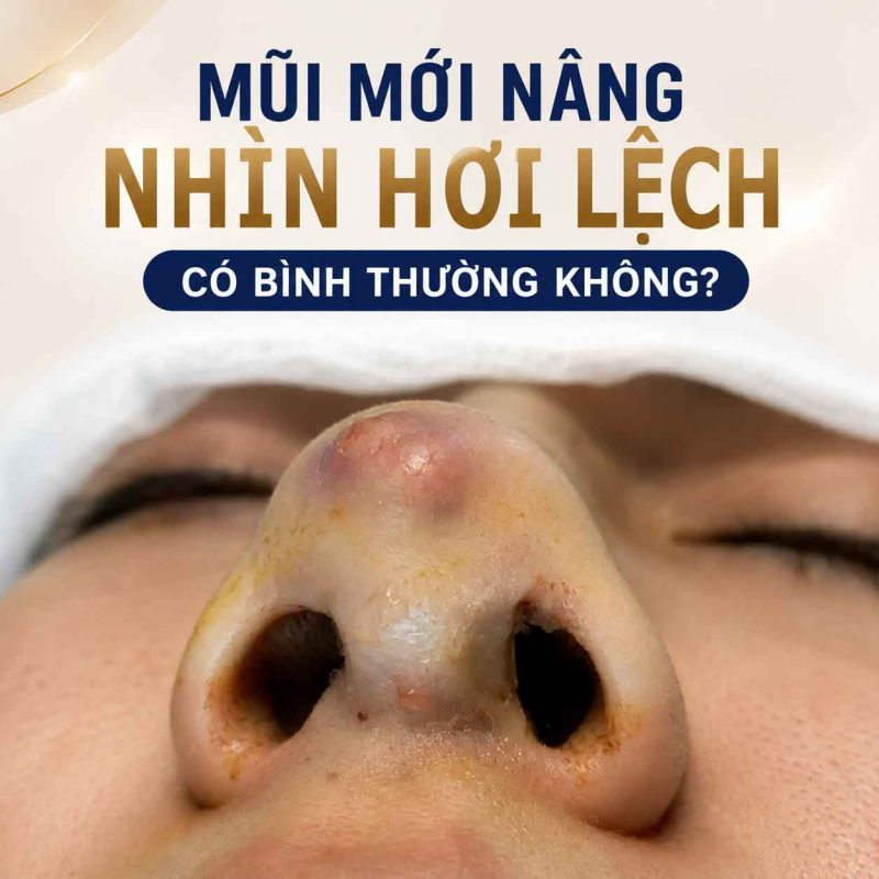 Mũi mới nâng nhìn hơi lệch có bình thường không