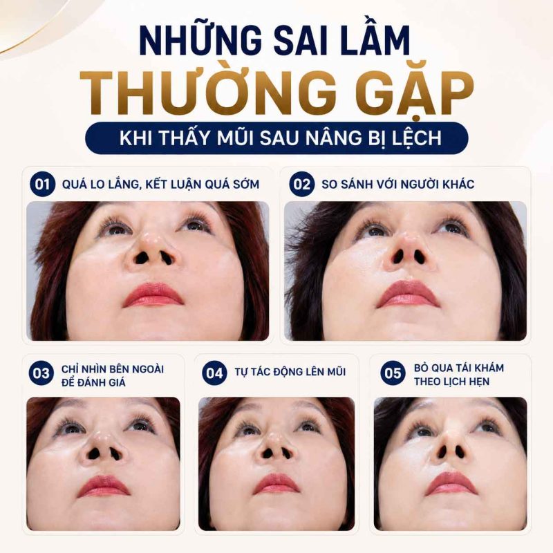 Những sai lầm thường gặp khi thấy mũi sau nâng bị lệch