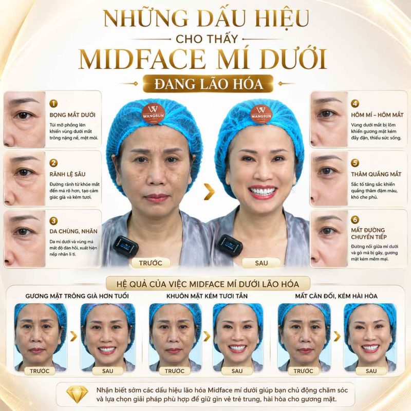 Phẫu Thuật Midface Là Gì? Có Giúp Cải Thiện Vùng Mắt Và Tầng Mặt Giữa Không? Những dấu hiệu cho thấy midface mí dưới đang lão hóa