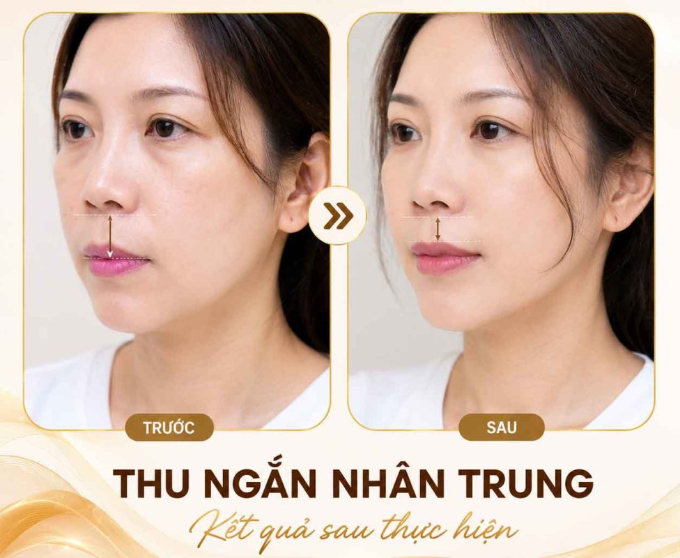 Nhân Trung Dài Ở Nữ Có Xấu Không? Đặc Điểm, Nguyên Nhân Và Cách Cải Thiện Thu ngắn nhân trung trước sau thực hiện