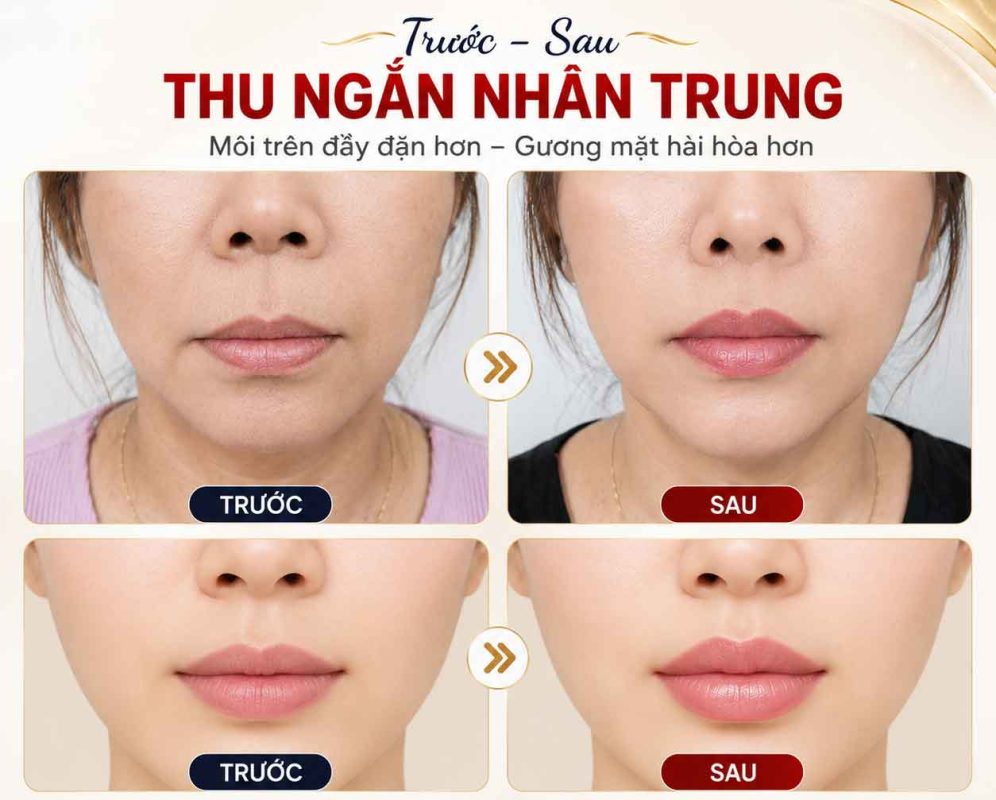 Thu Ngắn Nhân Trung Bao Lâu Thì Hồi Phục? Thời Gian Lành Thương Và Những Điều Cần Biết Trước sau thu ngắn nhân trung