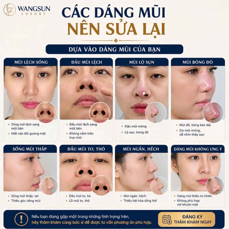 Sửa mũi lần 2 có khó hơn lần đầu không Các dáng mũi nên sửa lại