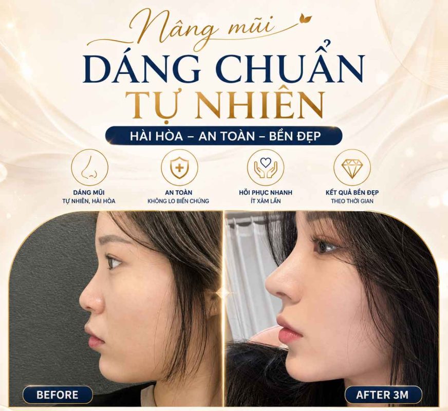 Khi nào cần tái khám sau nâng mũi Khi nào cần tái khám sau nâng mũi