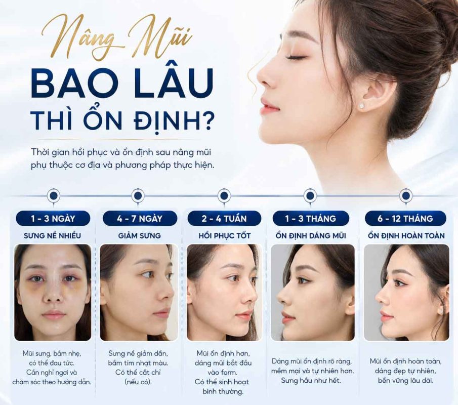 Nâng mũi bao lâu thì ổn định