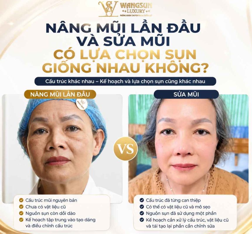 Nâng mũi lần đầu và sửa mũi có lựa chọn sụn giống nhau không? Nâng mũi lần đầu và sửa mũi có lựa chọn giống nhau không