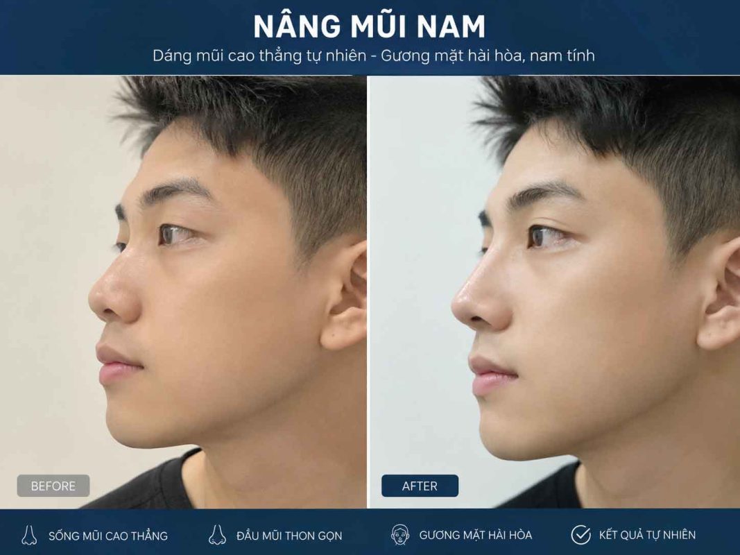 Nâng Mũi Nam Là Gì? Những Điều Nam Giới Cần Biết Trước Khi Thực Hiện Nâng mũi nam là gì