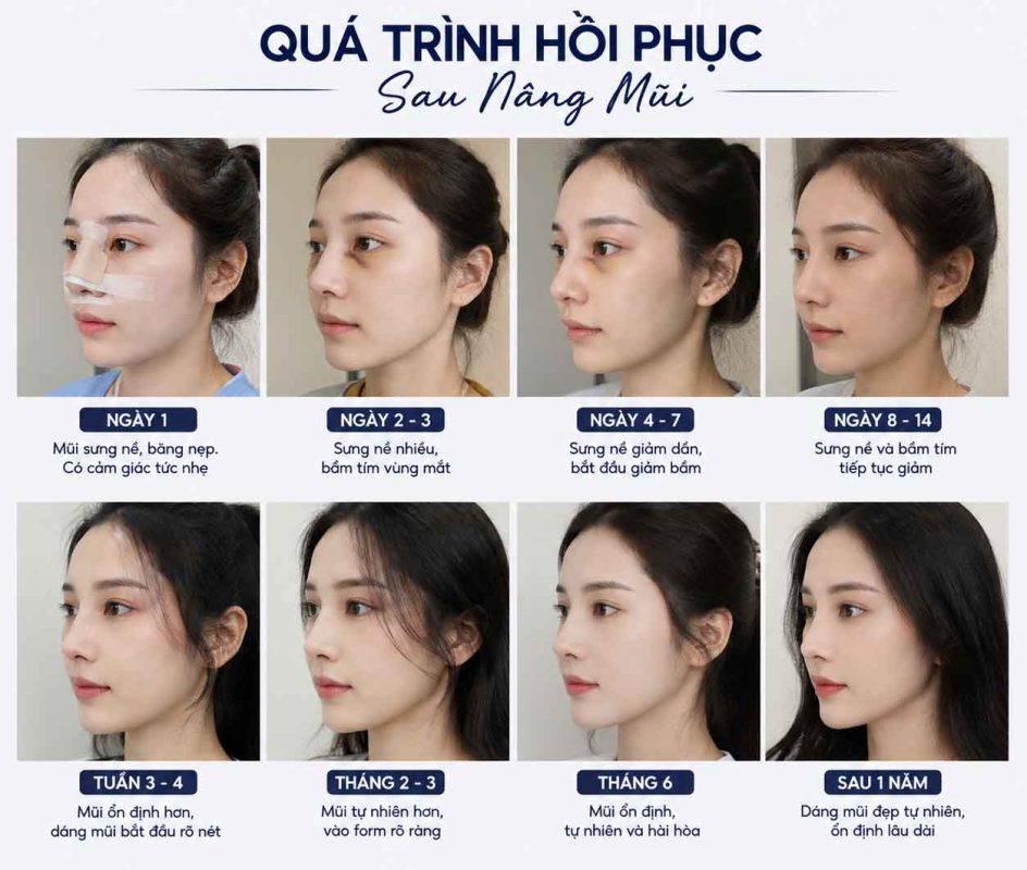 Quá trình hồi phục sau nâng mũi