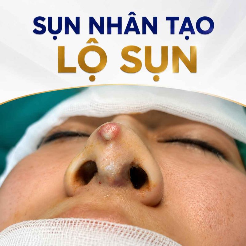 Nâng mũi sụn nhân tạo có an toàn không? Sụn nhân tạo lộ sụn