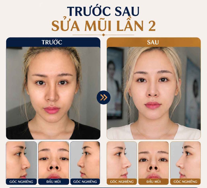 Sửa mũi lần 2 có khó hơn lần đầu không Trước sau sửa mũi lần 2