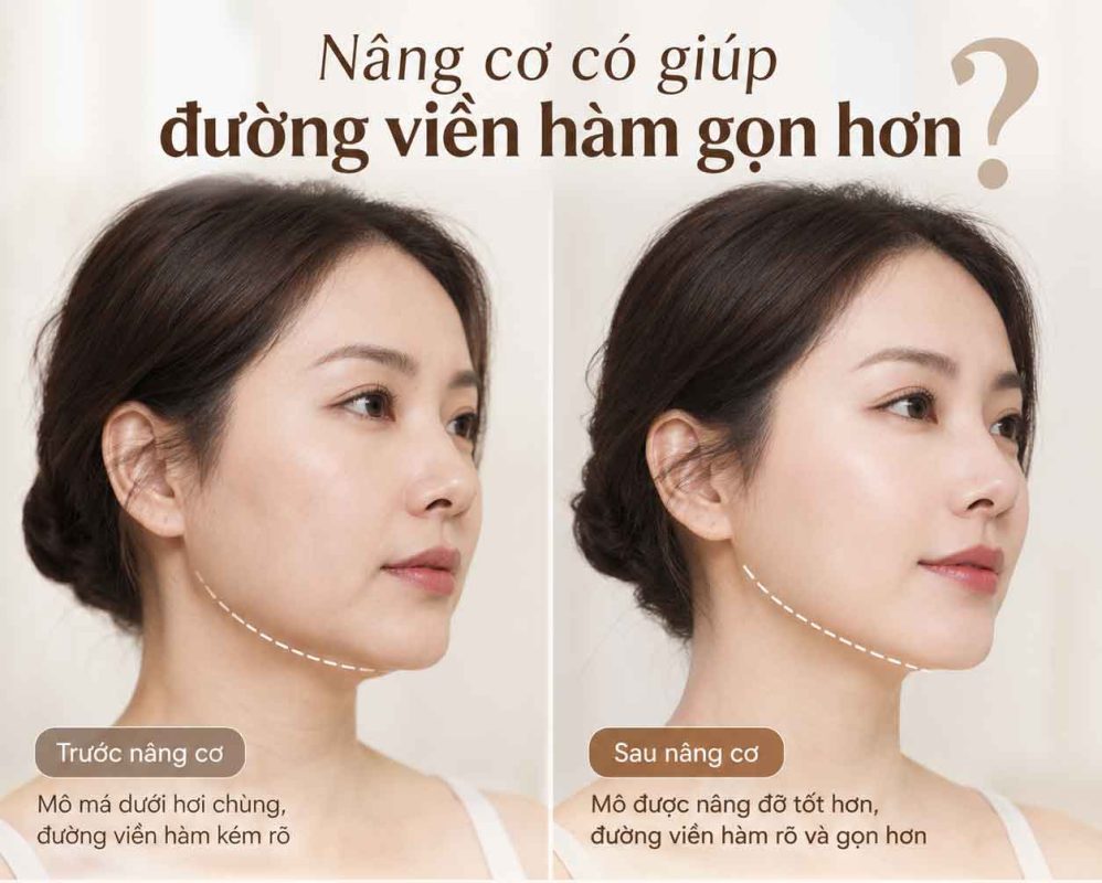 Nâng cơ có giúp đường viền hàm gọn hơn không