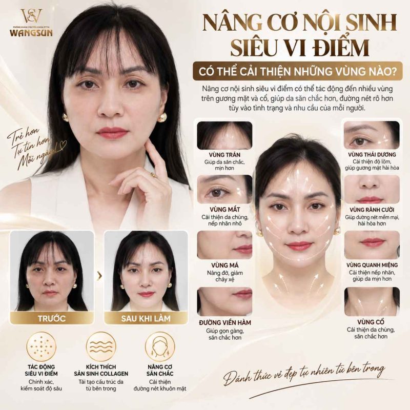 Nâng Cơ Nội Sinh Siêu Vi Điểm Không Phẫu Thuật Là Gì? Nâng cơn nội sinh siêu vi điểm cải thiện những vùng nào