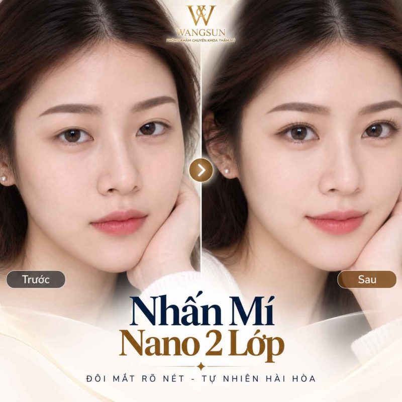Nhấn Mí Nano 2 Lớp Là Gì? Có Gì Khác Nhấn Mí Thông Thường? Nhấn mí nano 2 lớp trước sau thực hiện